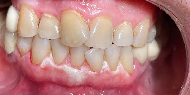 کردن دندان ها با لیزر دایود بعد از درمان