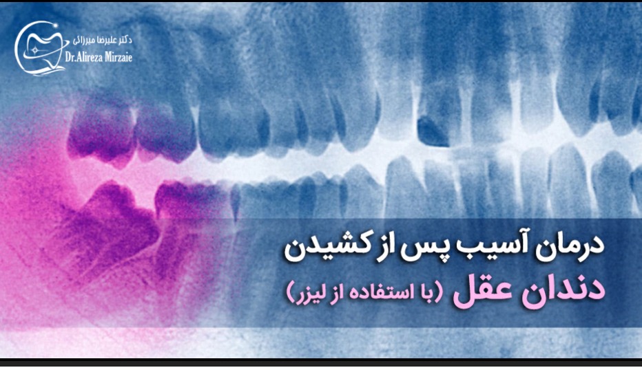 FireShot Capture 018 آسیب پس از کشیدن دندان عقل دکتر علیرضا میرزائی drmirzaie.com