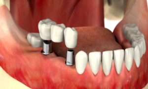 اینفوگرافیک انواع ایمپلنت دندانی -دکتر میرزائی