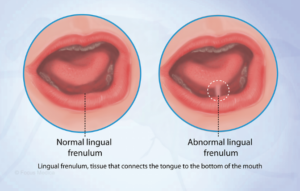 درمان گره زبانی (جراحی فرنوم) با لیزر