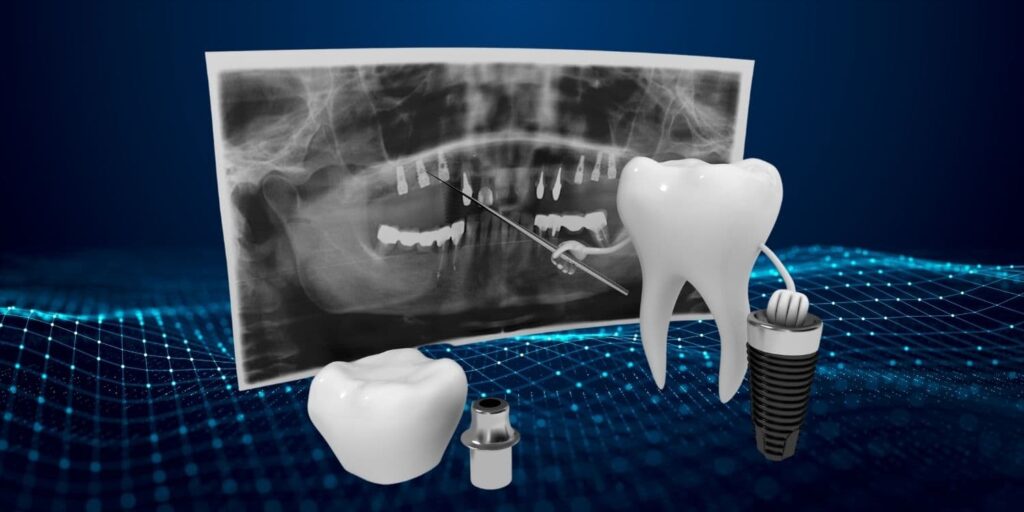 Digital Dental Implants 1