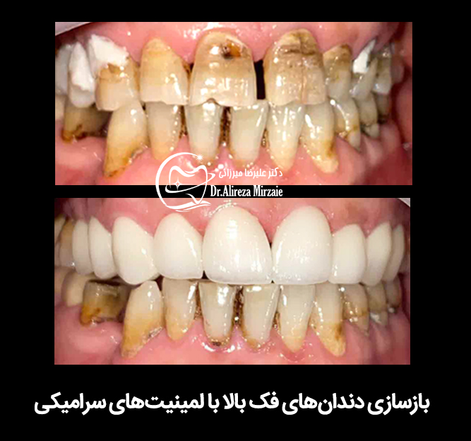 انواع روکش دندانی + طول عمر و مزایا و معایب آنها