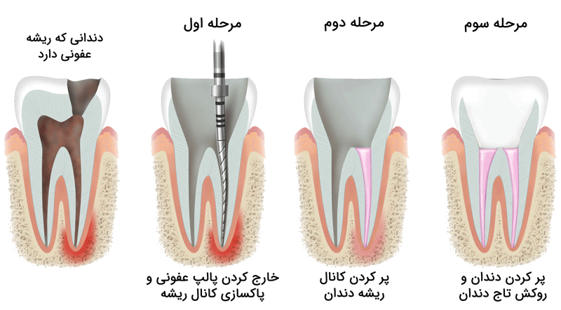 root canal therapy 02 1